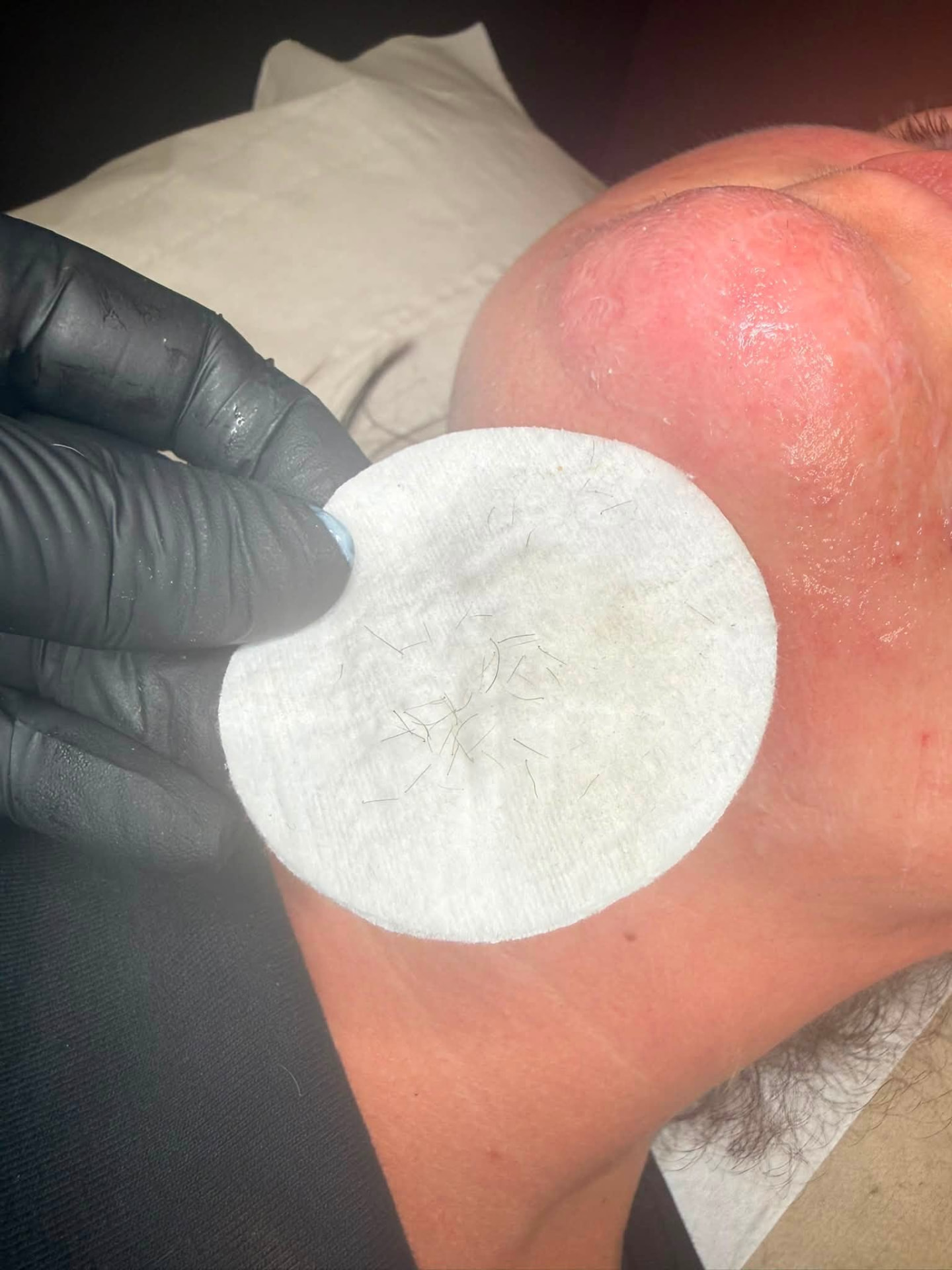 Cotton pad showing hairs removed during a chin electrolysis session in Longniddry