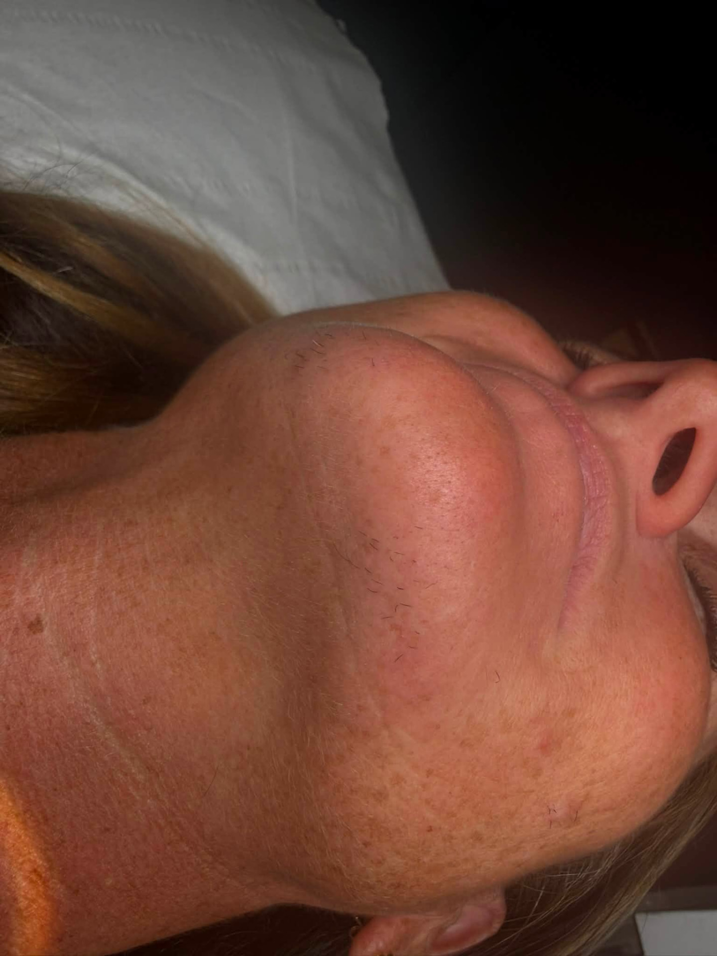 Calm, clear skin immediately after Apilus Epilase electrolysis on the chin at Rollo House