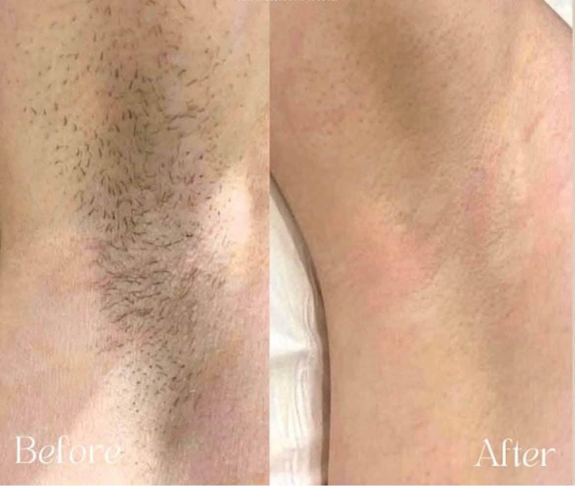 Underarm laser hair removal before and after showing smooth, hair-free skin in East Lothian