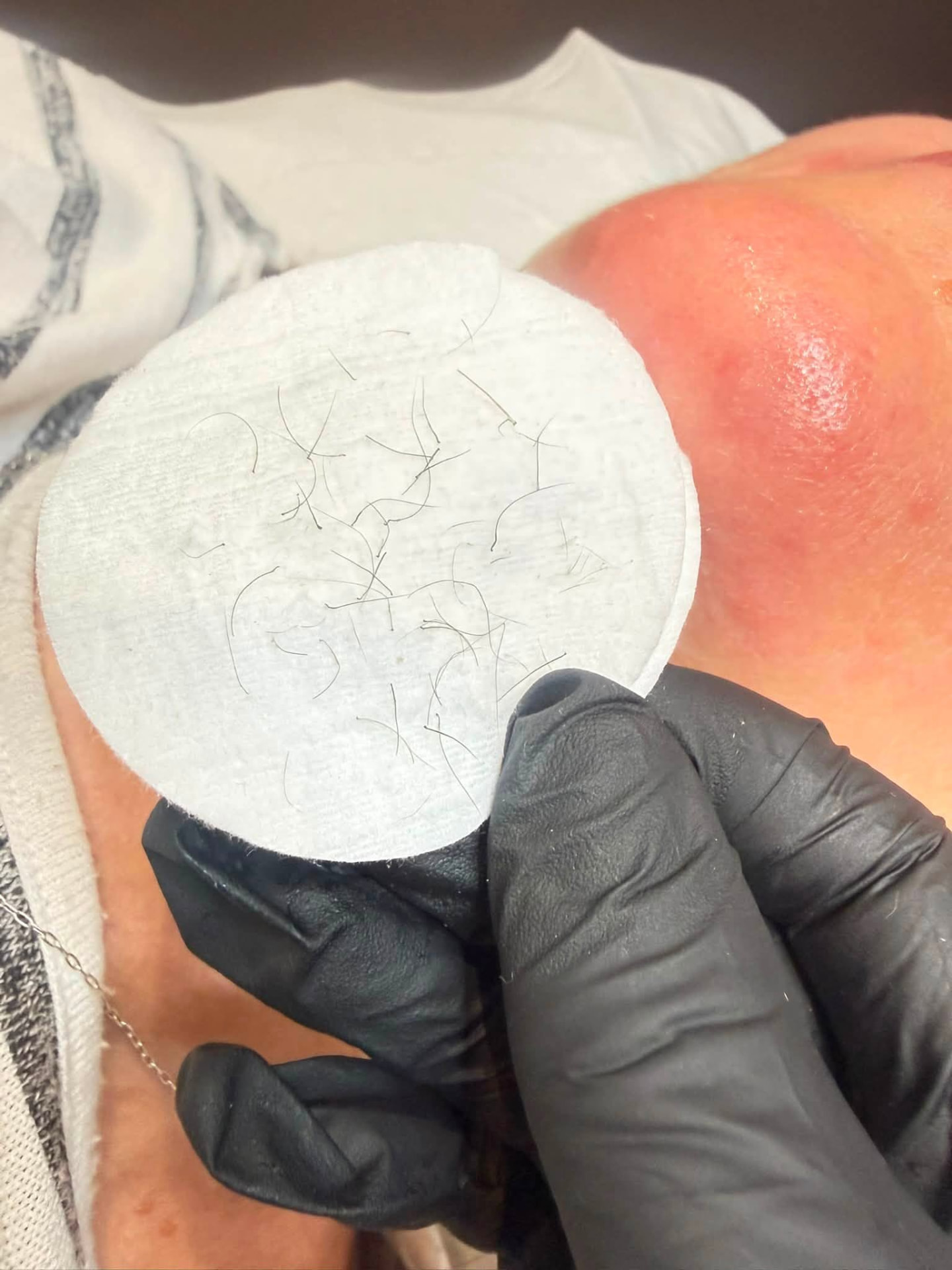 Volume of chin hairs cleared in a single Apilus Epilase electrolysis appointment