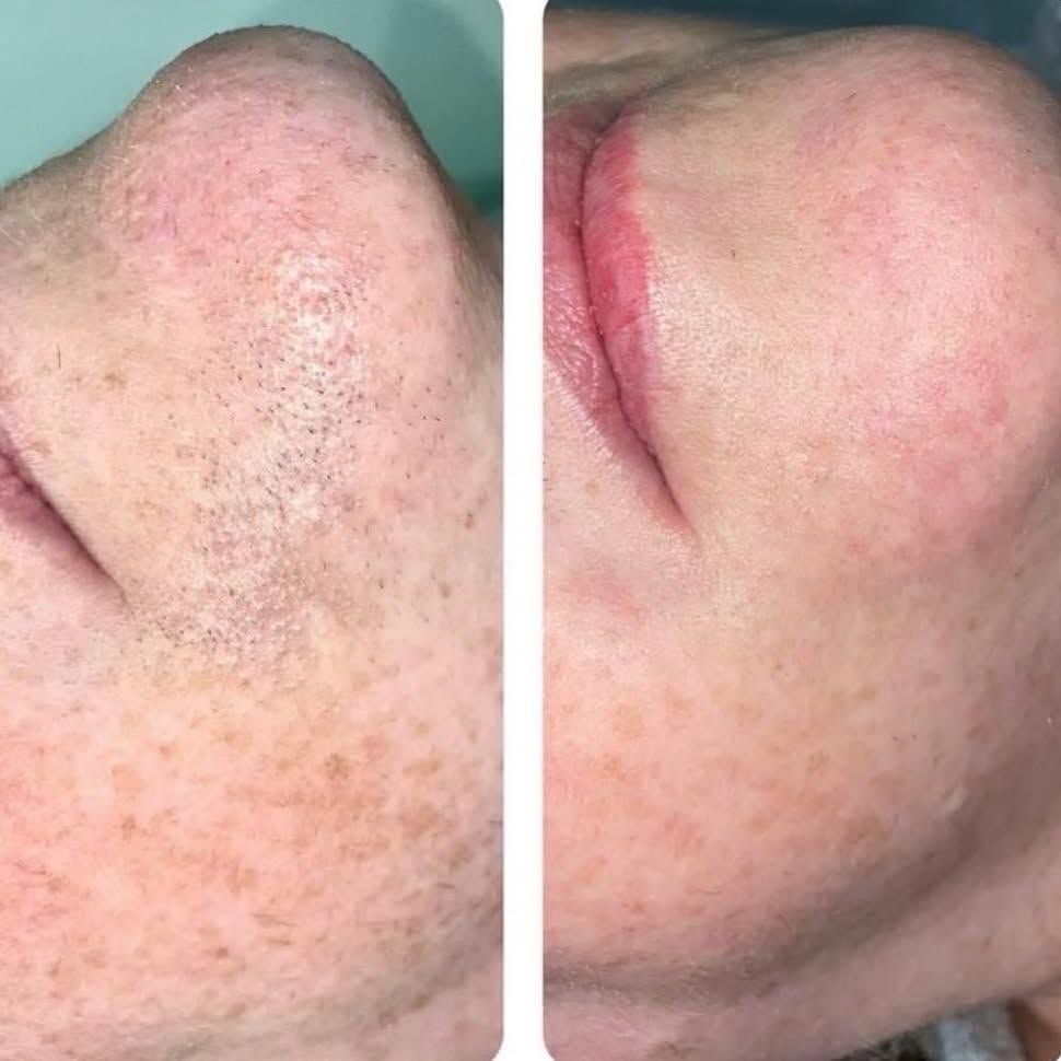Real Rollo House client, chin electrolysis before and after result