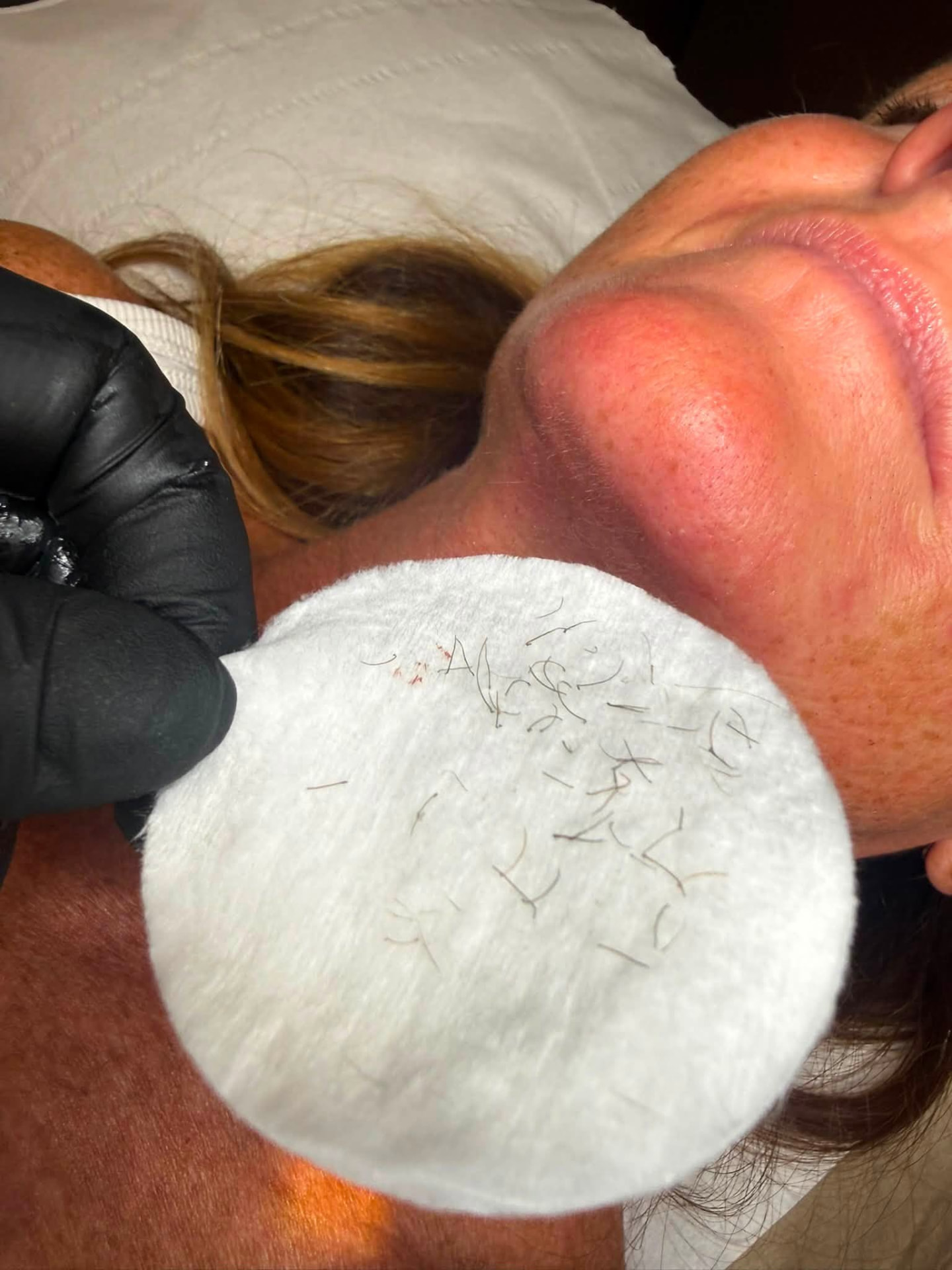 Post-electrolysis extraction of grey and dark chin hairs at Rollo House clinic