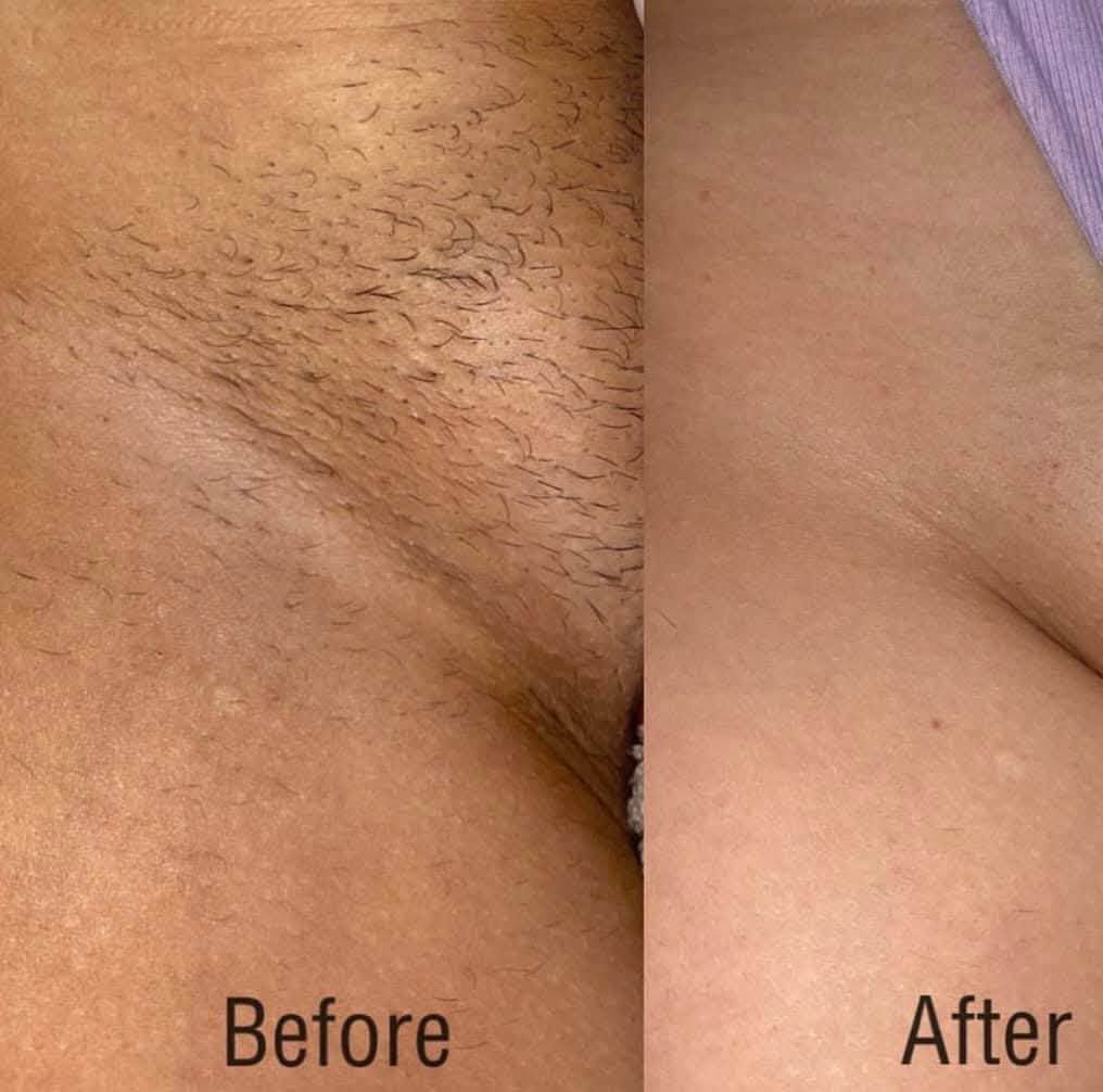 Bikini line laser hair removal before and after result at Rollo House, Longniddry