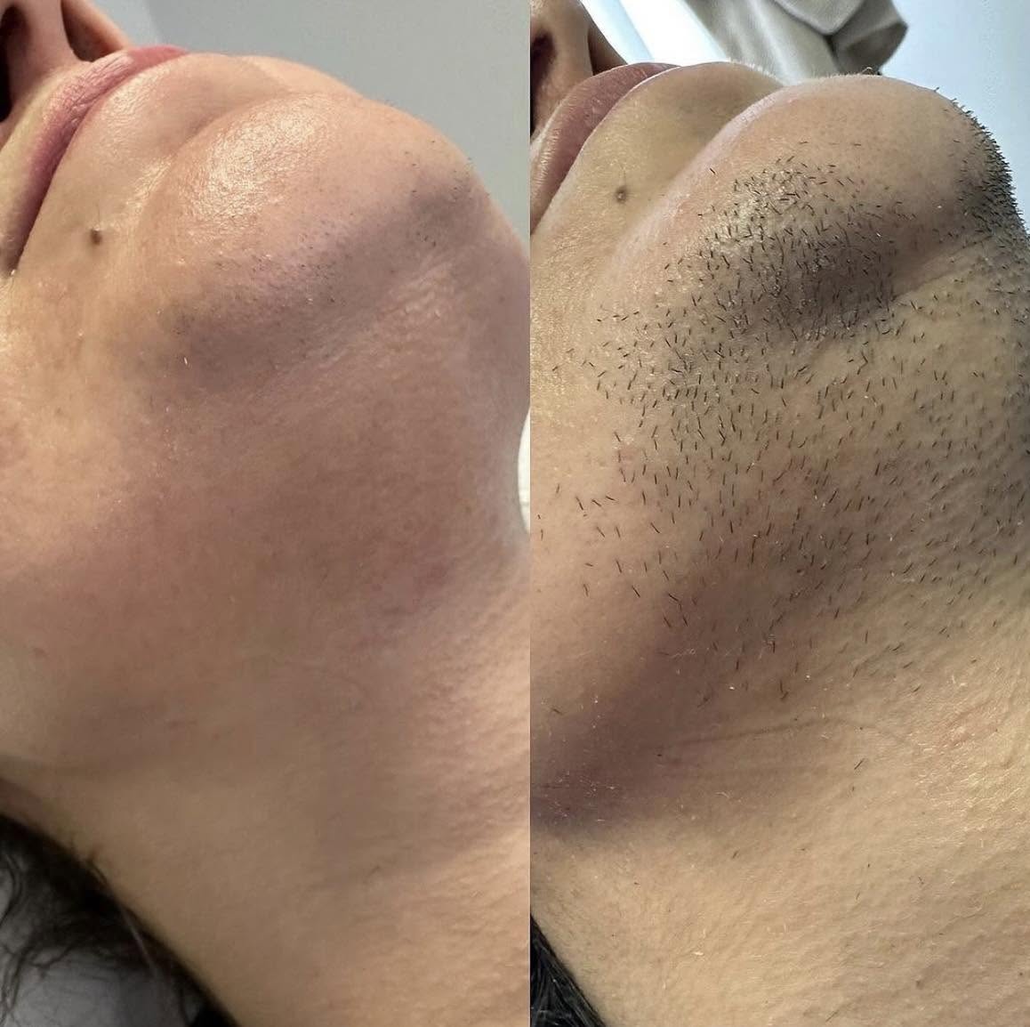Side-profile before and after of chin electrolysis treatment for dense facial hair in East Lothian